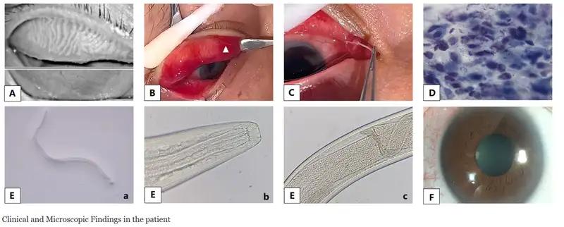У китаянки под веком нашли скопление червей-паразитов